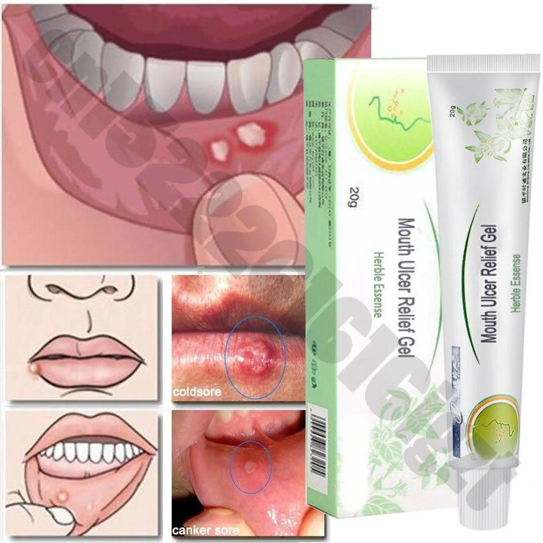 Mouth Ulcer Relief Gel Natural Herbal Oral Antibacterial Cream Fast Relief From Severe Pain Irritation Within 2 Minutes Lazada Singapore